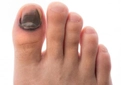 Ayak Tırnağı Morarması Belirtileri ve Tedavisi