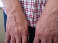 Damarda Morarma Belirtileri ve Tedavisi