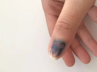 Tırnak Dibi Morarması Belirtileri ve Tedavisi