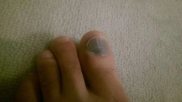 Ayak Baş Parmak Morarması Belirtileri ve Tedavisi