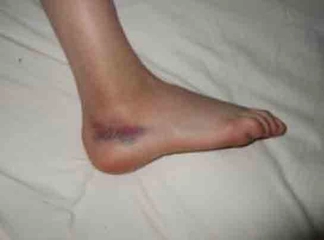 Ayak Bileğinde Morarma Belirtileri ve Tedavisi