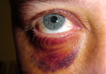 Darbe Sonucu Göz Morarması Nasıl Geçer?