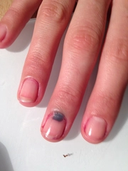 El Tırnak Morarması Belirtileri ve Tedavisi