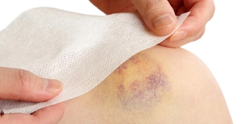 Lösemi Belirtileri Morarma Belirtileri ve Tedavisi